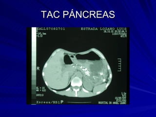 TAC PÁNCREAS 