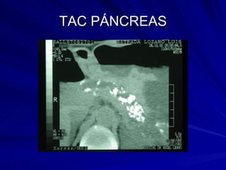 TAC PÁNCREAS 