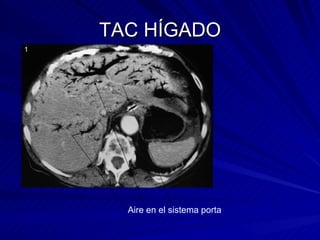 TAC HÍGADO Aire en el sistema porta 
