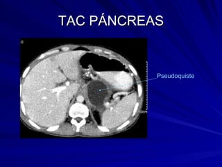 TAC PÁNCREAS Pseudoquiste 