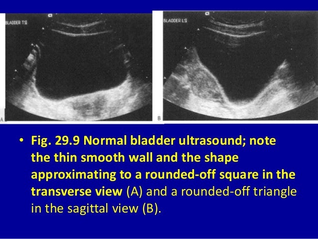 bladder ultrasound