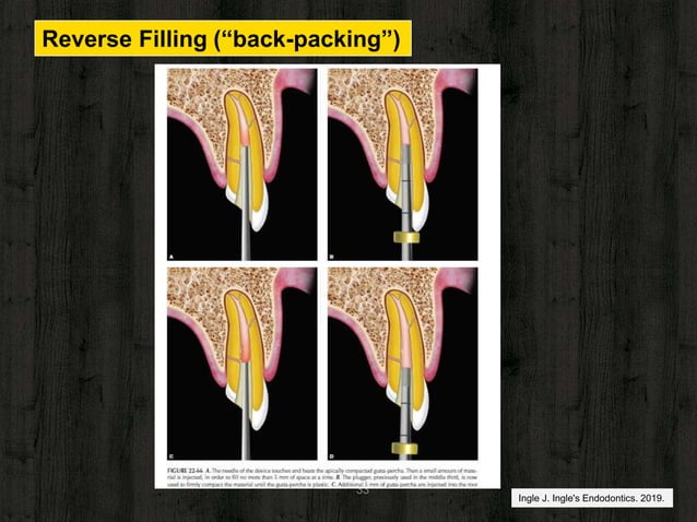TECHNIQUES OF OBTURATION | PPTX