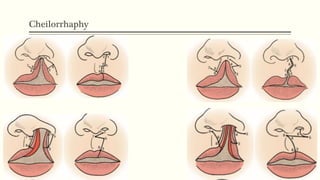 Cheilorrhaphy
 