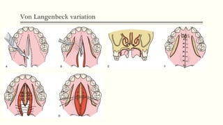 Von Langenbeck variation
 