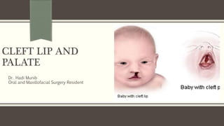 CLEFT LIP AND
PALATE
Dr. Hadi Munib
Oral and Maxillofacial Surgery Resident
 