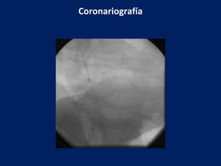 Coronariografía 