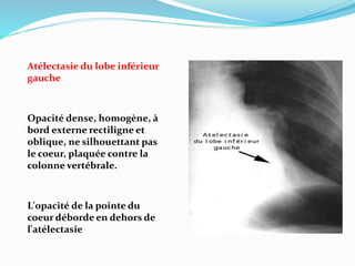Atélectasie du lobe inférieur
gauche
Opacité dense, homogène, à
bord externe rectiligne et
oblique, ne silhouettant pas
le coeur, plaquée contre la
colonne vertébrale.
L'opacité de la pointe du
coeur déborde en dehors de
l'atélectasie
 