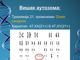 Вишак аутозома:
• Тризомија 21. хромозома- Down
  синдром
• Кариотип 47,XX(21+) ili 47,XY(21+)
 