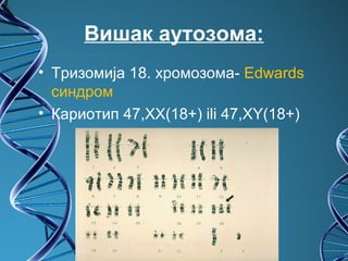 Вишак аутозома:
• Тризомија 18. хромозома- Edwards
  синдром
• Кариотип 47,XX(18+) ili 47,XY(18+)
 