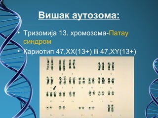 Вишак аутозома:
• Тризомија 13. хромозома-Патау
  синдром
• Кариотип 47,XX(13+) ili 47,XY(13+)
 