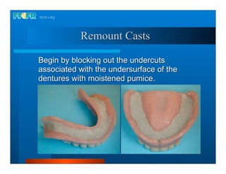 Remount Casts

Begin by blocking out the undercuts
associated with the undersurface of the
dentures with moistened pumice.
 