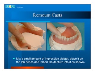 Remount Casts




   Mix a small amount of impression plaster, place it on
    the lab bench and imbed the denture into it as shown.
 