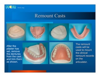 Remount Casts




                                 The remount
After the                        casts will be
plaster has
                                 used to mount
set, remove
the dentures                     the clinical
from the cast,                   remount records
and trim them                    on the
as shown.                        articulator.
 