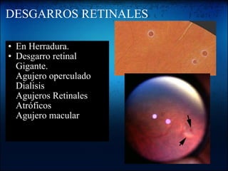 DESGARROS RETINALES En Herradura. Desgarro retinal Gigante. Agujero operculado Dialisis Agujeros Retinales Atróficos Agujero macular 