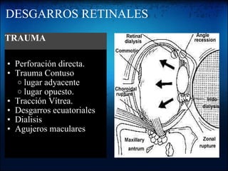 DESGARROS RETINALES   Perforación directa. Trauma Contuso lugar adyacente lugar opuesto. Tracción Vítrea. Desgarros ecuatoriales Dialisis Agujeros maculares TRAUMA 