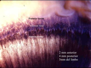 DESPRENDIMIENTO DE VÍTREO POSTERIOR   2 mm anterior 4 mm posterior 5mm del limbo 