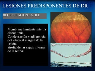 LESIONES PREDISPONENTES DE DR   Membrana limitante interna discontinua. Condensación y adherencia del vítreo al margen de la lesión. atrofia de las capas internas de la retina. DEGENERACION LATICE 