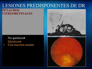 LESIONES PREDISPONENTES DE DR Son pequeñas elevaciones retinales causadas por areas focales de tracción vitrea o zonular se clasifican en:  ·      No quísticos ·      Quísticos ·       Con tracción zonular PENACHOS VITREORETINALES 