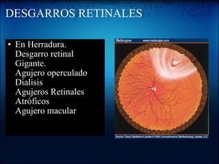 DESGARROS RETINALES En Herradura. Desgarro retinal Gigante. Agujero operculado Dialisis Agujeros Retinales Atróficos Agujero macular   