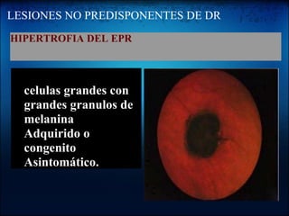 LESIONES NO PREDISPONENTES DE DR HIPERTROFIA DEL EPR   celulas grandes con grandes granulos de melanina Adquirido o congenito Asintomático.  