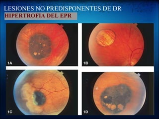 LESIONES NO PREDISPONENTES DE DR HIPERTROFIA DEL EPR 