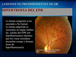 LESIONES NO PREDISPONENTES DE DR HIPERTROFIA DEL EPR      La forma congenita se ha asociado a Sx Garner. La forma adquirida se encuentra en etapas tardias. las  celulas del EPR son hipofluorecentes mientras  que los vasos coroideos presentan escape y forman  áreas de hiperfluorecencia                                     