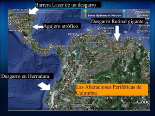 Desgarro Retinal gigante Barrera Laser de un desgarro Desgarro en Herradura Agujero atrófico   Las Alteraciones Periféricas de    Colombia 