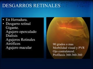 DESGARROS RETINALES En Herradura. Desgarro retinal Gigante. Agujero operculado Dialisis Agujeros Retinales Atróficos Agujero macular      90 grados o mas      Morbilidad visual y PVR      Ojo contralateral.      Profilaxis 360-360-360 