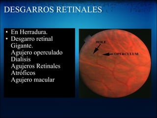 DESGARROS RETINALES En Herradura. Desgarro retinal Gigante. Agujero operculado Dialisis Agujeros Retinales Atróficos Agujero macular   