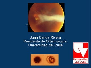 Toxocara Canis Juan Carlos Rivera Residente de Oftalmología. Universidad del Valle 