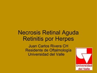 Necrosis Retinal Aguda Retinitis por Herpes Juan Carlos Rivera CH Residente de Oftalmología Universidad del Valle     
