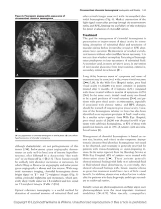 Circumscribed choroidal hemangioma Mashayekhi and Shields 145

Figure 3. Fluorescein angiographic appearance of                                     other retinal changes associated with circumscribed cho-
circumscribed choroidal hemangioma.
                                                                                     roidal hemangioma (Fig. 6). Marked attenuation of the
                                                                                     light signal occurs after passing through the neurosensory
                                                                                     retina and RPE, limiting the usefulness of this technique
                                                                                     for direct evaluation of choroidal tumors.

                                                                                     Treatment
                                                                                     The goal for management of choroidal hemangioma is
                                                                                     preservation or improvement of visual acuity by stimu-
                                                                                     lating absorption of subretinal fluid and resolution of
                                                                                     macular edema before irreversible retinal or RPE alter-
                                                                                     ations have occurred. Re-treatment of residual extrafo-
                                                                                     veal tumors without subretinal fluid is not necessary. It is
                                                                                     not yet clear whether incomplete flattening of hemangi-
                                                                                     omas predisposes to later recurrence of subretinal fluid.
                                                                                     A secondary goal, in more advanced cases, is prevention
                                                                                     of neovascular glaucoma from long-standing, extensive,
                                                                                     secondary retinal detachment [11].

                                                                                     Long delay between onset of symptoms and onset of
                                                                                     treatment may be associated with a worse visual outcome
                                                                                     [2••,17,18]. In the Wills Eye Hospital series, poor final
                                                                                     visual acuity ( 20/200) was more common in patients
                                                                                     treated after 6 months of symptoms (72%) compared
                                                                                     with those treated within 6 months of symptoms (42%)
                                                                                     [2••]. In the same study, initial visual acuity was found
                                                                                     to be a good predictor of visual outcome [2••], and pa-
                                                                                     tients with poor visual acuity at presentation, especially
                                                                                     if associated with chronic retinal and RPE changes,
                                                                                     should be warned of long-term poor visual acuity. Loca-
                                                                                     tion of the hemangioma relative to fovea has also been
                                                                                     identified as an important predictor of final visual acuity.
                                                                                     In a smaller series reported from Wills Eye Hospital,
                                                                                     poor visual acuity of 20/200 was obtained in 69% of pa-
                                                                                     tients with subfoveal hemangioma, in 47% of those with
                                                                                     parafoveal tumors, and in 38% of patients with an extra-
                                                                                     foveal tumor [4].

(A) Lacy appearance of choroidal hemangioma in arterial phase. (B) Late, diffuse
                                                                                     Management of choroidal hemangioma is based on tu-
hyperfluorescence of choroidal hemangioma.
                                                                                     mor size, location, and related ocular symptoms. Asymp-
                                                                                     tomatic circumscribed choroidal hemangiomas only need
although characteristic, are not pathognomonic of this                               to be observed, and treatment is generally reserved for
tumor [2••]. Indocyanine green angiography demon-                                    patients with vision-threatening or vision-impairing le-
strates an early well-defined area of intense hyperfluo-                             sions. In the series reported from the Oncology Service at
rescence, often followed by a characteristic “dye wash-                              Wills Eye Hospital, 43% of patients were treated with
out” in late frames (Fig. 4) [14,15]. These features would                           observation alone [2••]. These patients generally
be unlikely with choroidal melanoma or metastasis, for                               showed minimal findings with little or no subretinal fluid
which filling on fluorescein angiography and indocyanine                             or fluid-related visual disturbances, or, conversely, they
green angiography is slower and less intense. With mag-                              showed advanced findings with chronic macular edema
netic resonance imaging, choroidal hemangioma shows                                  so great that treatment would have been of little visual
bright signal on T1- and T2-weighted images (Fig. 5)                                 benefit. In addition, observation with refraction is advis-
unlike choroidal melanoma and metastasis, which gen-                                 able for patients who have hyperopic amblyopia second-
erally show bright signal on T1-weighted and low signal                              ary to subfoveal tumors.
on T2-weighted images (Table 2) [16].
                                                                                     Initially xenon arc photocoagulation and later argon laser
Optical coherence tomography is a useful method for                                  photocoagulation were the most important treatment
detection of minimal amounts of subretinal fluid and                                 modalities [2••,4,19]. More recently, transpupillary
 