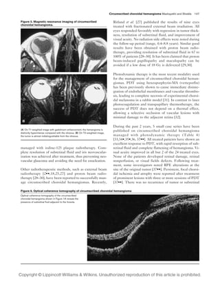 Circumscribed choroidal hemangioma Mashayekhi and Shields 147

Figure 5. Magnetic resonance imaging of circumscribed                             Ritland et al. [27] published the results of nine eyes
choroidal hemangioma.
                                                                                  treated with fractionated external beam irradiation. All
                                                                                  eyes responded favorably with regression in tumor thick-
                                                                                  ness, resolution of subretinal fluid, and improvement of
                                                                                  visual acuity. No radiation side effects were noted during
                                                                                  the follow-up period (range, 0.4–8.8 years). Similar good
                                                                                  results have been obtained with proton beam radio-
                                                                                  therapy, providing resolution of subretinal fluid in 67 to
                                                                                  100% of patients [28–30]. It has been claimed that proton
                                                                                  beam-induced papillopathy and maculopathy can be
                                                                                  avoided if a low dose of 18 Gy is delivered [29,30].

                                                                                  Photodynamic therapy is the most recent modality used
                                                                                  for the management of circumscribed choroidal heman-
                                                                                  giomas. PDT using benzoporphyrin-MA (verteporfin)
                                                                                  has been previously shown to cause immediate disinte-
                                                                                  gration of endothelial membranes and vascular thrombo-
                                                                                  sis, leading to complete necrosis of experimental choroi-
                                                                                  dal melanoma in a rabbit model [31]. In contrast to laser
                                                                                  photocoagulation and transpupillary thermotherapy, the
                                                                                  success of PDT does not depend on a thermal effect,
                                                                                  allowing a selective occlusion of vascular lesions with
                                                                                  minimal damage to the adjacent retina [32].

                                                                                  During the past 2 years, 5 small case series have been
(A) On T1-weighted image with gadolinium enhancement, the hemangioma is
                                                                                  published on circumscribed choroidal hemangioma
distinctly hyperintense compared with the vitreous. (B) On T2-weighted image,
the tumor is almost indistinguishable from the vitreous.                          managed with photodynamic therapy (Table 4)
                                                                                  [33,34•,35•,36, 37••]. All treated patients have shown an
                                                                                  excellent response to PDT, with rapid resorption of sub-
managed with iodine-125 plaque radiotherapy. Com-                                 retinal fluid and complete flattening of hemangioma. Vi-
plete resolution of subretinal fluid and iris neovascular-                        sual acuity improved in all but 2 of the 24 treated eyes.
ization was achieved after treatment, thus preventing neo-                        None of the patients developed retinal damage, retinal
vascular glaucoma and avoiding the need for enucleation.                          nonperfusion, or visual fields defects. Following treat-
                                                                                  ment, some investigators noted RPE alterations at the
Other radiotherapeutic methods, such as external beam                             site of the original tumor [37••]. Persistent, focal choroi-
radiotherapy [2••,18,25,27] and proton beam radio-                                dal ischemia and atrophy were reported after treatment
therapy [28–30], have been reported to successfully man-                          of prominent lesions with three or more sessions of PDT
age circumscribed choroidal hemangiomas. Recently,                                [37••]. There was no recurrence of tumor or subretinal

Figure 6. Optical coherence tomography of circumscribed choroidal hemangioma
Optical coherence tomography of the circumscribed
choroidal hemangioma shown in Figure 1A reveals the
presence of subretinal fluid adjacent to the foveola.
 