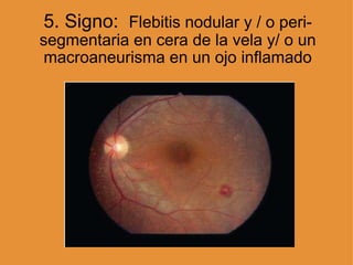 5. Signo:   Flebitis nodular y / o peri-segmentaria en cera de la vela y/ o un macroaneurisma en un ojo inflamado 