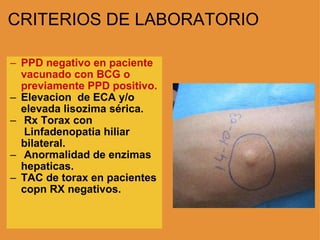 CRITERIOS DE LABORATORIO PPD negativo en paciente vacunado con BCG o previamente PPD positivo. Elevacion  de ECA y/o elevada lisozima sérica.   Rx Torax con  Linfadenopatia hiliar bilateral.   Anormalidad de enzimas hepaticas. TAC de torax en pacientes copn RX negativos. 