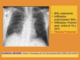 CLINICAL REVIEW,  Owen J Dempsey,et Col Sarcoidosis,BMJ 2009;339:b320 6 BHL solamente. Infiltrados pulmonares+ BHL. Infiltrados. Pulmonares  entre el 10 y 20% . Fibrosis Pulmonar  