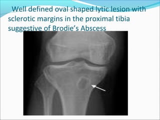 Tibia Abscess Dr. Pradeep Patil (M.D. Radiodiagnosis) Prof D Y Patil, Kolhapur | PPT