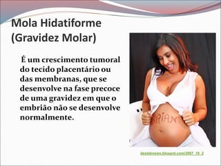 Mola Hidatiforme
(Gravidez Molar)
É um crescimento tumoral
do tecido placentário ou
das membranas, que se
desenvolve na fase precoce
de uma gravidez em que o
embrião não se desenvolve
normalmente.
destaknews.blospot.com/2007_10_2
 