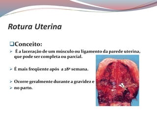 Rotura Uterina
Conceito:
 É a laceração de um músculo ou ligamento da parede uterina,
que pode ser completa ou parcial.
 É mais freqüente após a 28ª semana.
 Ocorre geralmente durante a gravidez e
 no parto.
 