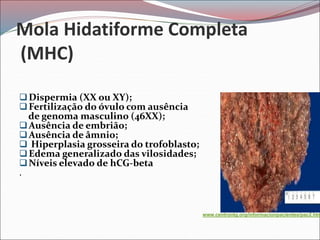 Mola Hidatiforme Completa
(MHC)
Dispermia (XX ou XY);
Fertilização do óvulo com ausência
de genoma masculino (46XX);
Ausência de embrião;
Ausência de âmnio;
 Hiperplasia grosseira do trofoblasto;
Edema generalizado das vilosidades;
Níveis elevado de hCG-beta
.
 www.centrontg.org
www.centrontg.org/informacionpacientes/pac2.htm
 
