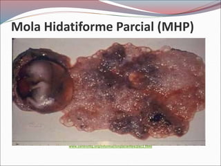 Mola Hidatiforme Parcial (MHP)
www.centrontg.org/informacionpacientes/pac2.html
 