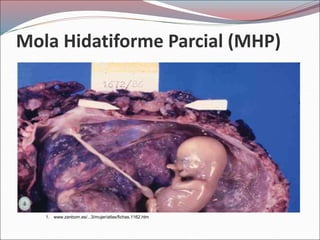 Mola Hidatiforme Parcial (MHP)
1. www.zanbom.es/...3/mujer/atlas/fichas.1162.htm
 