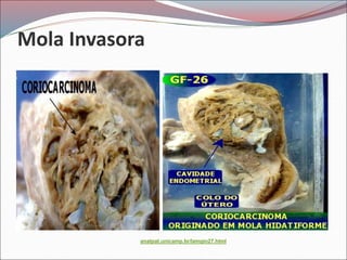 Mola Invasora
anatpat.unicamp.br/lamgin27.html
 
