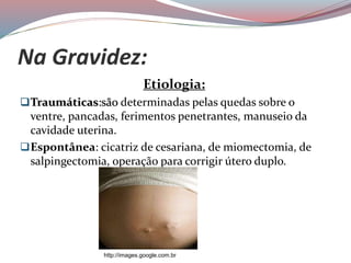 Na Gravidez:
Etiologia:
Traumáticas:são determinadas pelas quedas sobre o
ventre, pancadas, ferimentos penetrantes, manuseio da
cavidade uterina.
Espontânea: cicatriz de cesariana, de miomectomia, de
salpingectomia, operação para corrigir útero duplo.
http://images.google.com.br
 