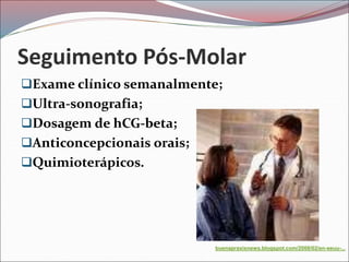 Seguimento Pós-Molar
Exame clínico semanalmente;
Ultra-sonografia;
Dosagem de hCG-beta;
Anticoncepcionais orais;
Quimioterápicos.
buenapraxisnews.blogspot.com/2008/02/en-eeuu-...
 