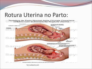 Rotura Uterina no Parto:
hon.nucleusinc.com
 