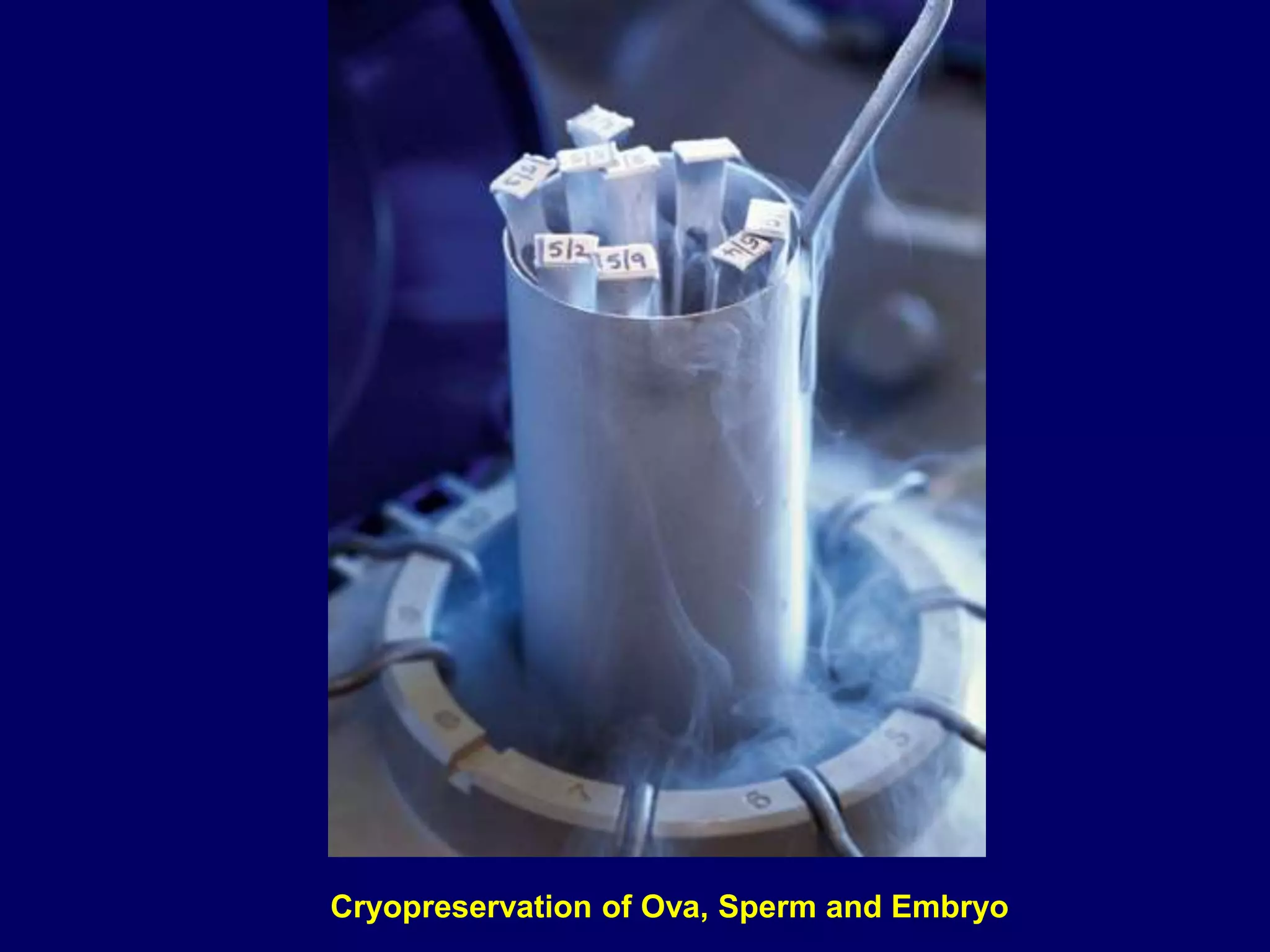 Cryopreservation of Ova, Sperm and Embryo
 