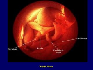 Viable Fetus
 