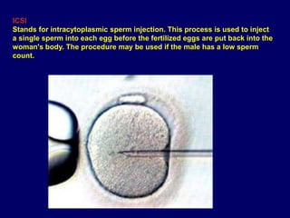 ICSI
Stands for intracytoplasmic sperm injection. This process is used to inject
a single sperm into each egg before the fertilized eggs are put back into the
woman's body. The procedure may be used if the male has a low sperm
count.
 