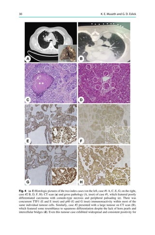 Lung Cancer Pathophysiology An Interdisciplinary Approach Nima Rezaei | PDF